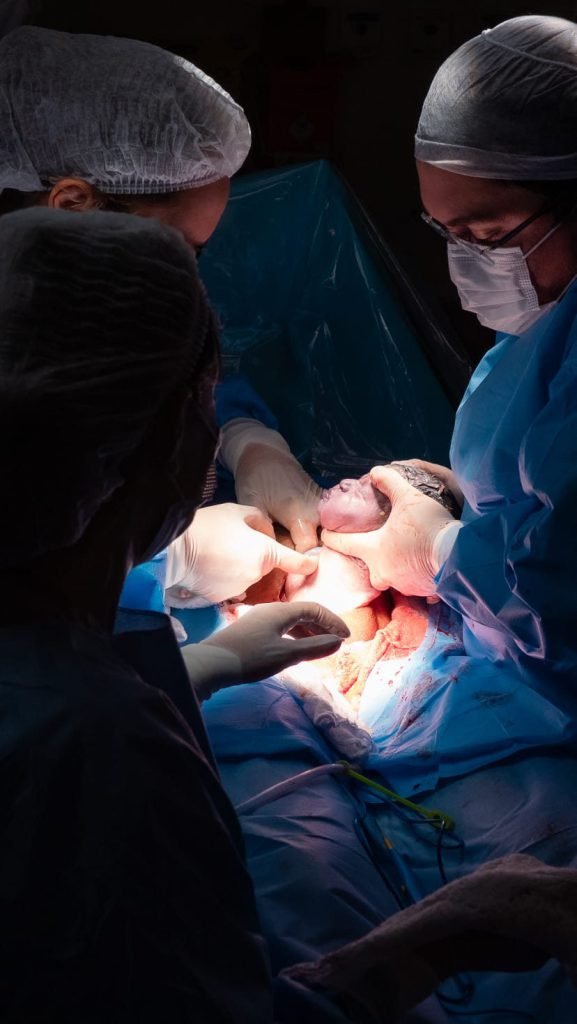 Equipe obstétrica de touca e máscara em torno da mesa cirúrgica no momento em que o bebê nasce, sob a luz do foco do centro cirúrgico